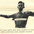 A boy stands with arms extended using splints.