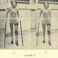 Two photographs of a woman walking with two canes and a leg brace.