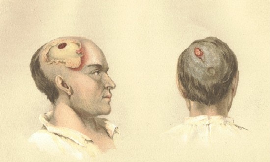 Two images of a man who had a musket ball pass through his head.