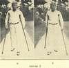 Two photographs of a young man walking with crutches.