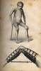 Two pictures:Top picture-little boy on crutches; Bottom picture-leg bent at knee with a brace from ankle to thigh