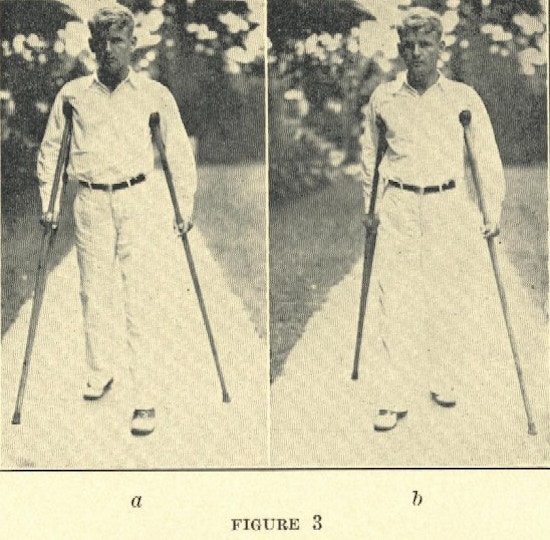 Two photographs of a young man walking with crutches.