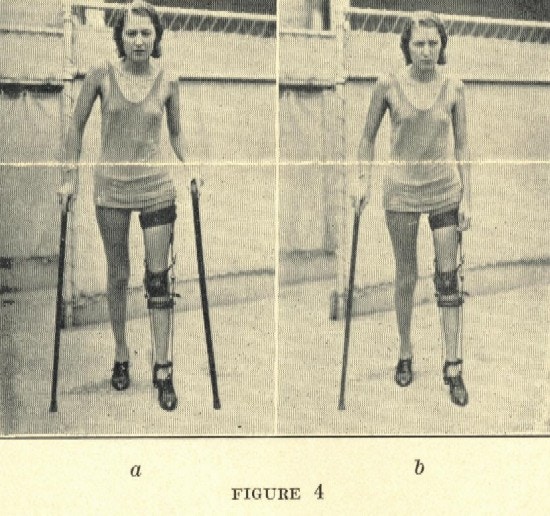 Two photographs of a woman walking with two canes and a leg brace.