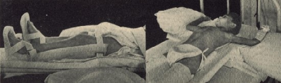 A boy lies in bed wearing splints.
